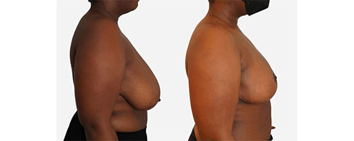 Remodelage des seins avec mastopexie Tunisie