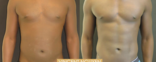 Chirurgie ventre plat avec lipoaspiration