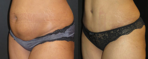 Correction du ventre par abdominoplastie Tunisie