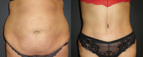 Abdominoplastie en Tunisie - Health and Care