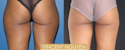 Résultat lipoaspiration cuisse et hanches Tunisie