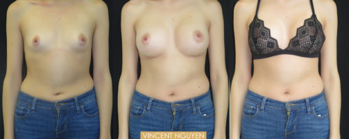 Augmentation mammaire avec implants silicone - Tunisie - Health and Care